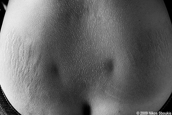 Back Dimples